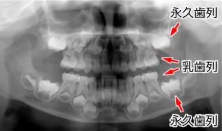 レントゲン像