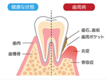 歯周内科について